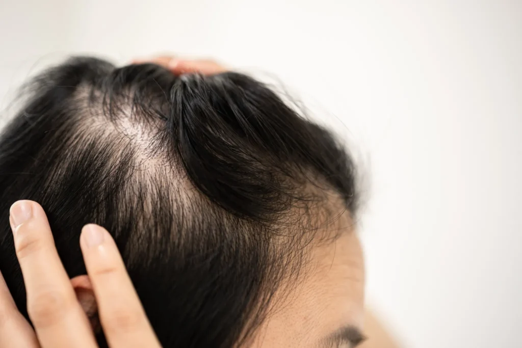 Androgenetic Alopecia causing gradual hair thinning and reduced scalp hair density