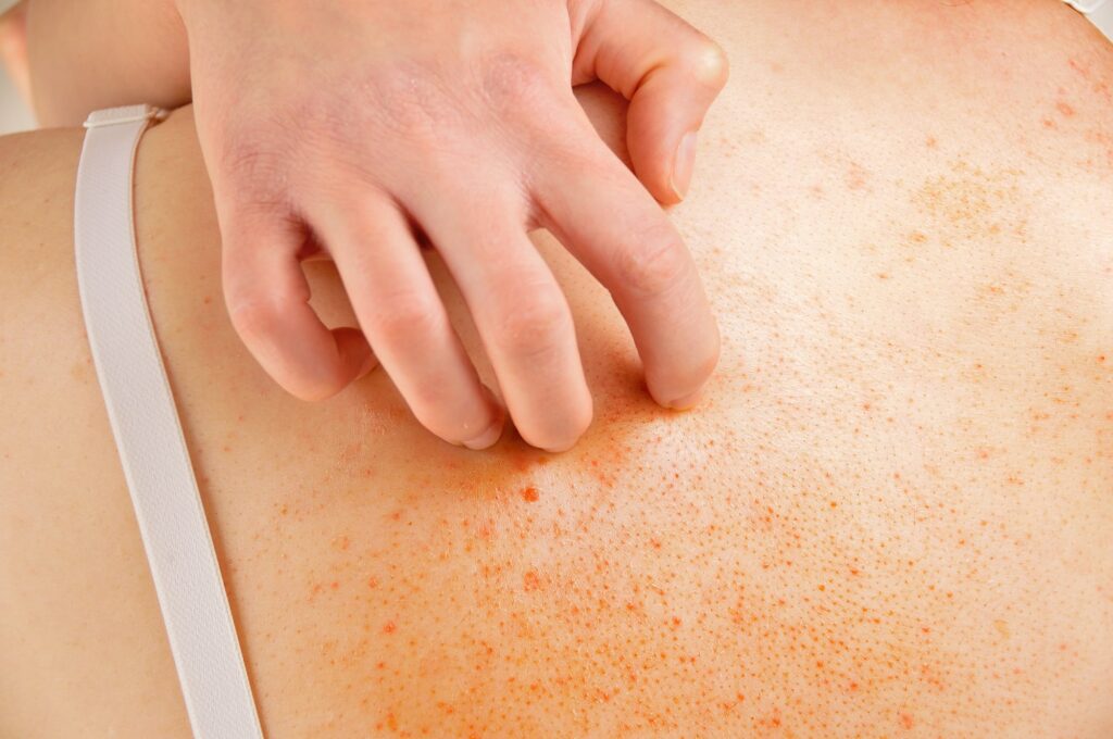 Exfoliative Dermatitis causing red, irritated, and peeling skin