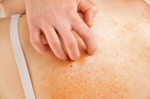 Exfoliative Dermatitis causing red, irritated, and peeling skin