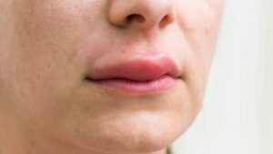 Acquired angioedema symptoms showing facial and skin swelling