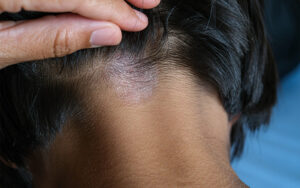 Tinea Capitis causing scalp irritation and hair loss