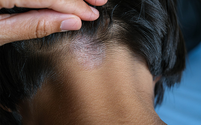 Tinea Capitis causing scalp irritation and hair loss