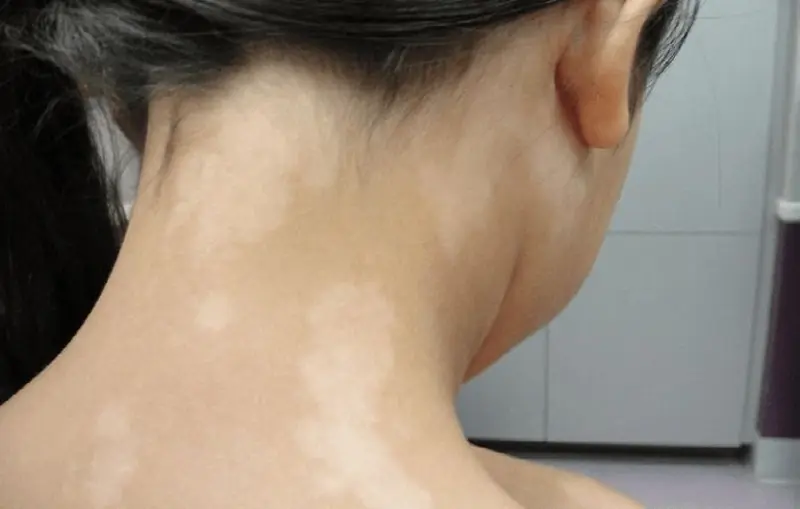 Tinea Versicolor causing light and dark patches on the skin